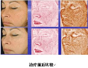 VISIA面部圖像分析儀產品介紹 VISIA面部圖像分析儀產品介紹